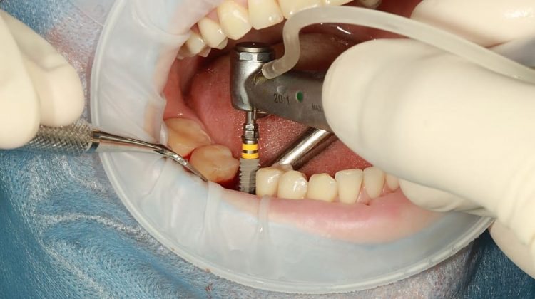 dental-implant-surgery (1)
